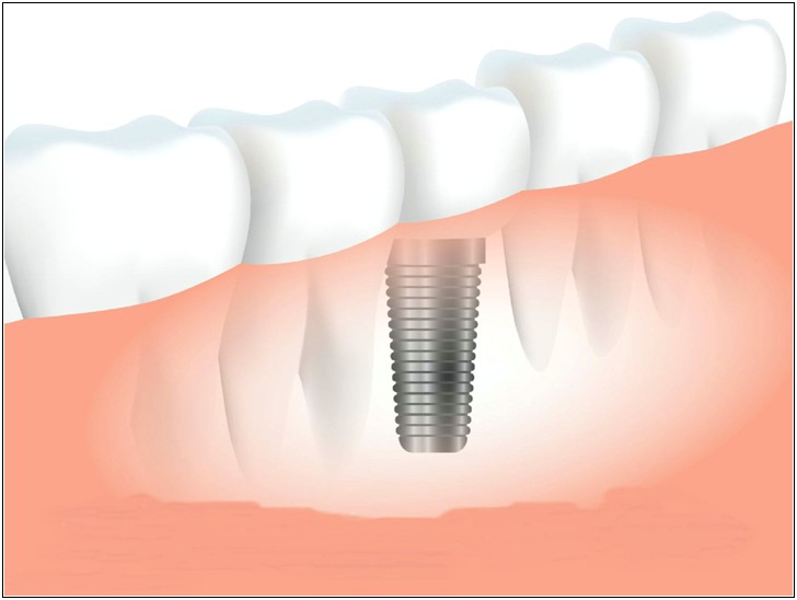 Dental Implant Ppt Template Free Download